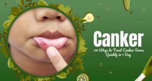 Ways to Treat Canker Sores